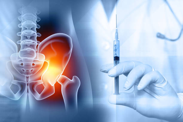 Bipolar Hip Hemiarthroplasty