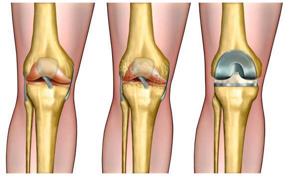 Joint Replacement Surgery