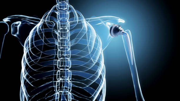 Joint Replacement