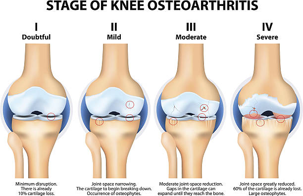Why do People Need Knee Replacements?
