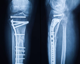 Partial Knee Replacement